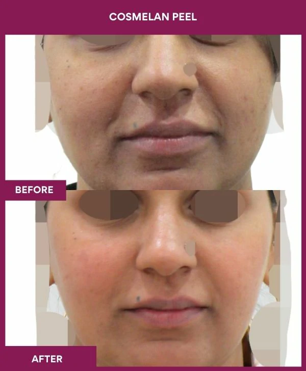 cosmelan-peel-treatment-before-after-results-mumbai-india-patient01-front