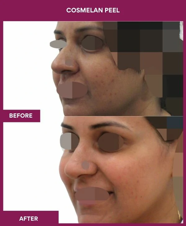 cosmelan-peel-treatment-before-after-results-mumbai-india-patient01-side-left-2