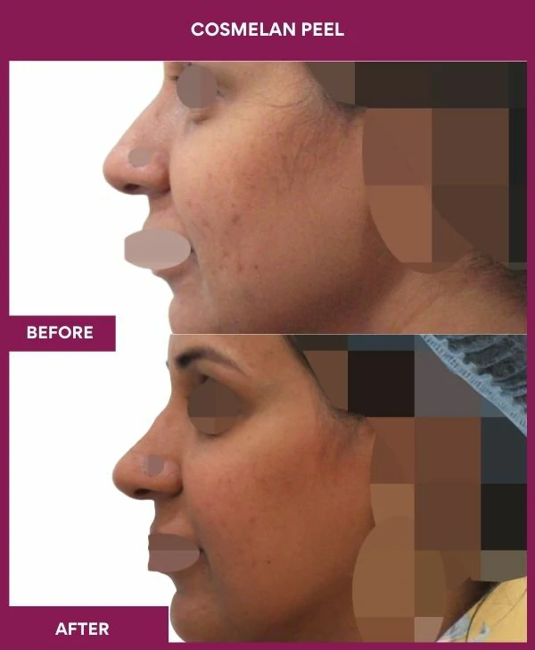 cosmelan-peel-treatment-before-after-results-mumbai-india-patient01-side-left