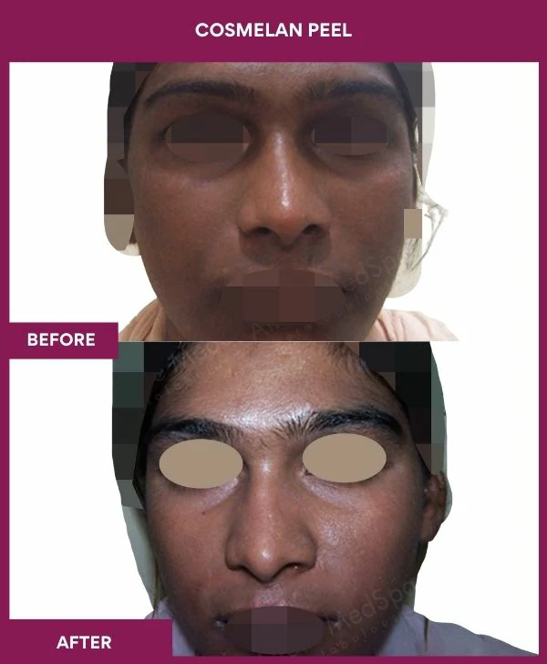 cosmelan-peel-treatment-before-after-results-mumbai-india-patient02-front