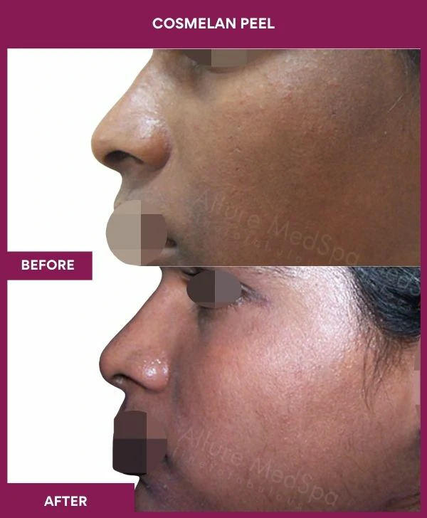 cosmelan-peel-treatment-before-after-results-mumbai-india-patient02-side-left