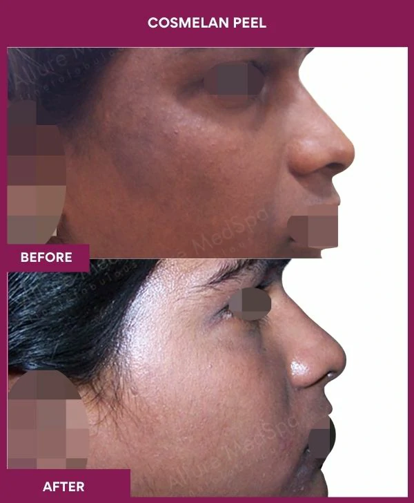 cosmelan-peel-treatment-before-after-results-mumbai-india-patient02-side-right