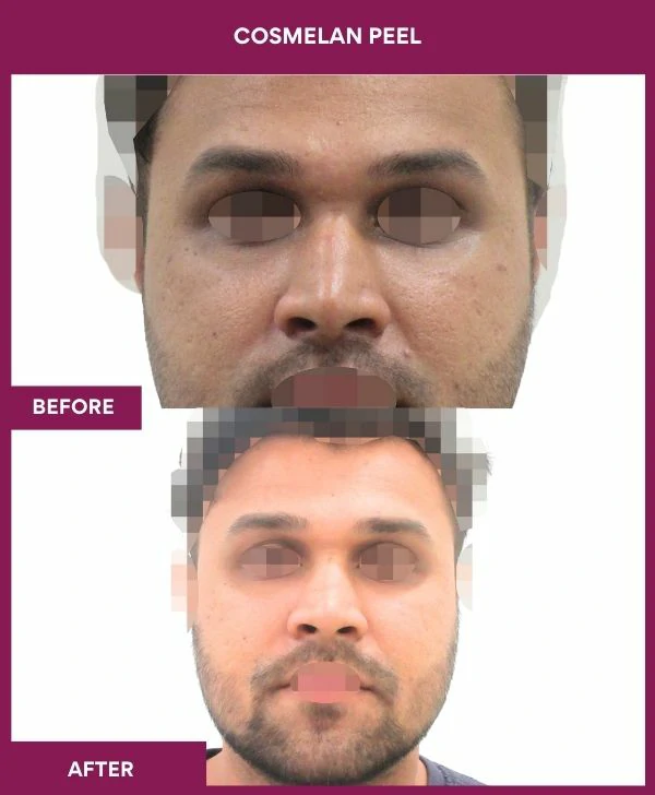 cosmelan-peel-treatment-before-after-results-mumbai-india-patient03-front