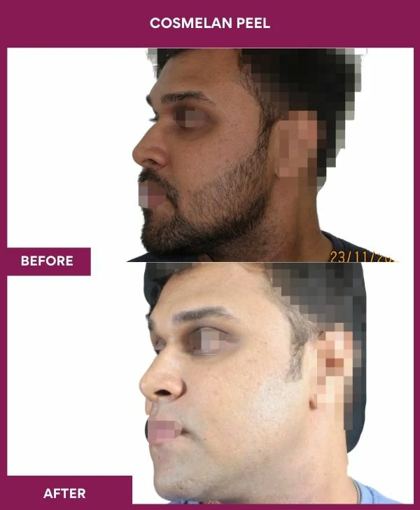 cosmelan-peel-treatment-before-after-results-mumbai-india-patient03-side-left