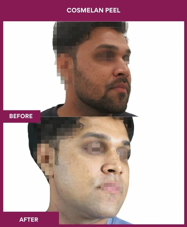 cosmelan-peel-treatment-before-after-results-mumbai-india-patient03-side-right