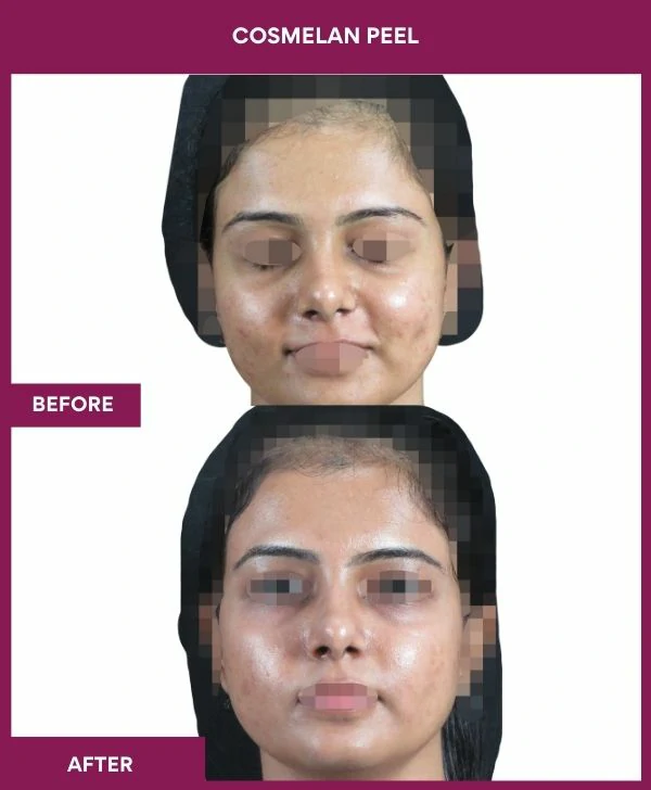 cosmelan-peel-treatment-before-after-results-mumbai-india-patient04-front