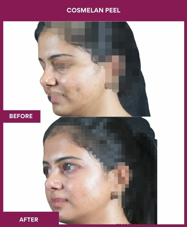 cosmelan-peel-treatment-before-after-results-mumbai-india-patient04-side-left