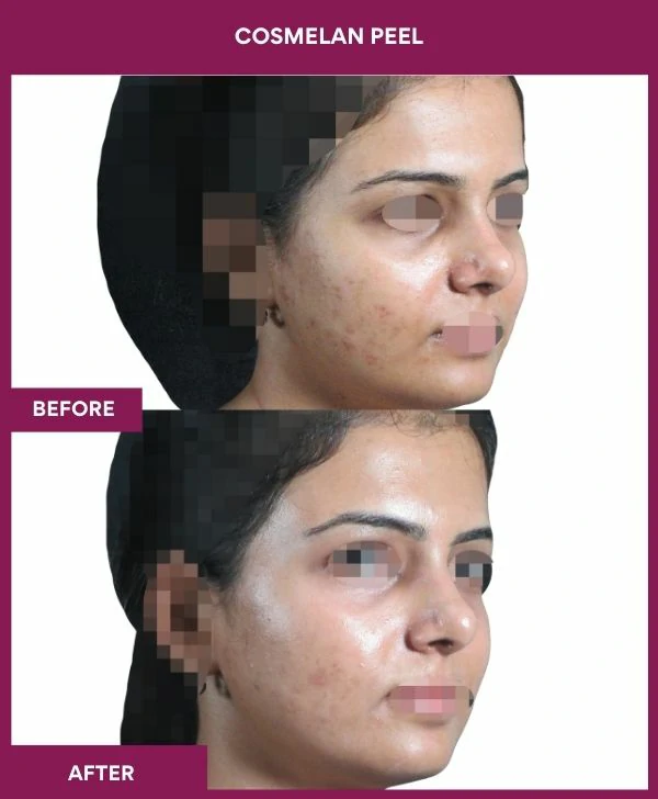 cosmelan-peel-treatment-before-after-results-mumbai-india-patient04-side-right