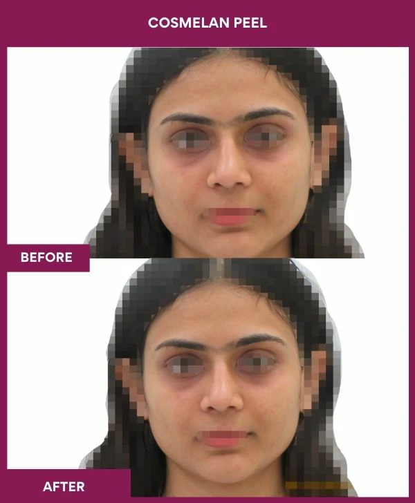 cosmelan-peel-treatment-before-after-results-mumbai-india-patient05-front