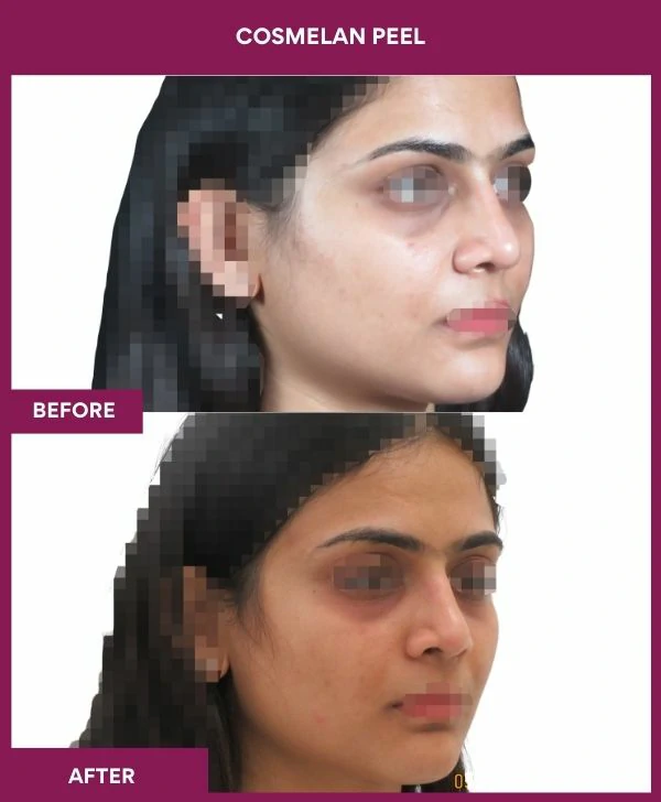 cosmelan-peel-treatment-before-after-results-mumbai-india-patient05-side-left
