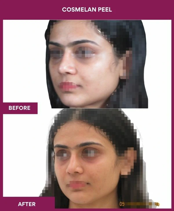 cosmelan-peel-treatment-before-after-results-mumbai-india-patient05-side-right