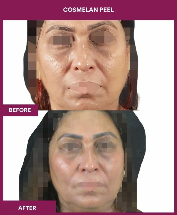 cosmelan-peel-treatment-before-after-results-mumbai-india-patient06-front
