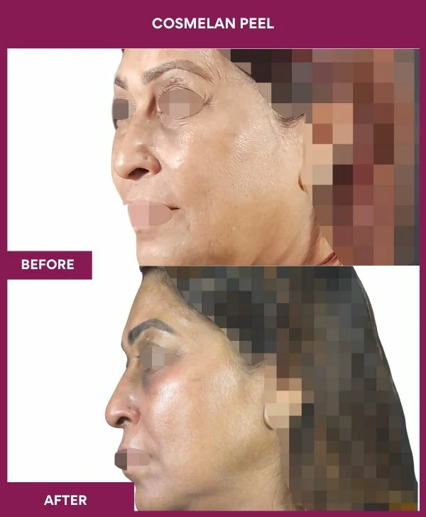cosmelan-peel-treatment-before-after-results-mumbai-india-patient06-side-left