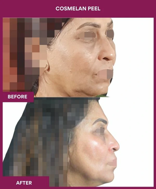 cosmelan-peel-treatment-before-after-results-mumbai-india-patient06-side-right