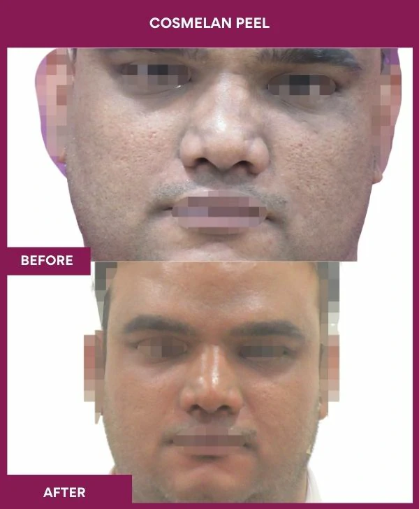 cosmelan-peel-treatment-before-after-results-mumbai-india-patient07-front