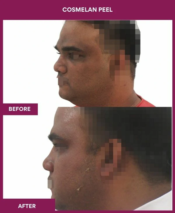 cosmelan-peel-treatment-before-after-results-mumbai-india-patient07-side-left