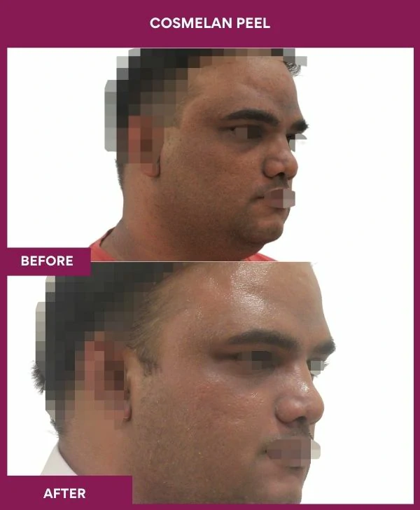 cosmelan-peel-treatment-before-after-results-mumbai-india-patient07-side-right