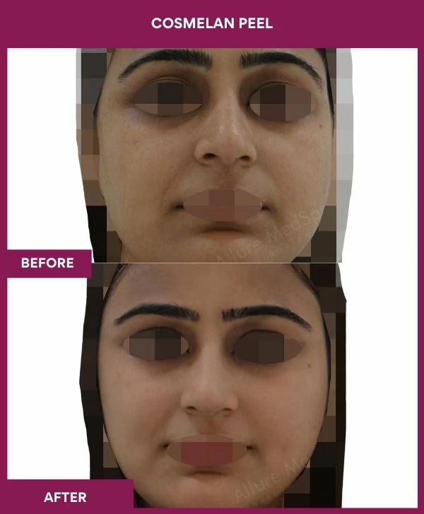 cosmelan-peel-treatment-before-after-results-mumbai-india-patient08-front