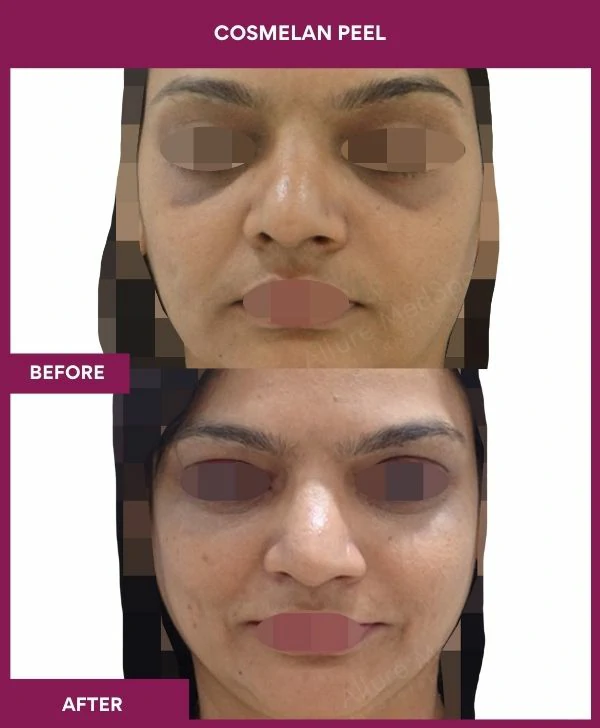 cosmelan-peel-treatment-before-after-results-mumbai-india-patient09-front