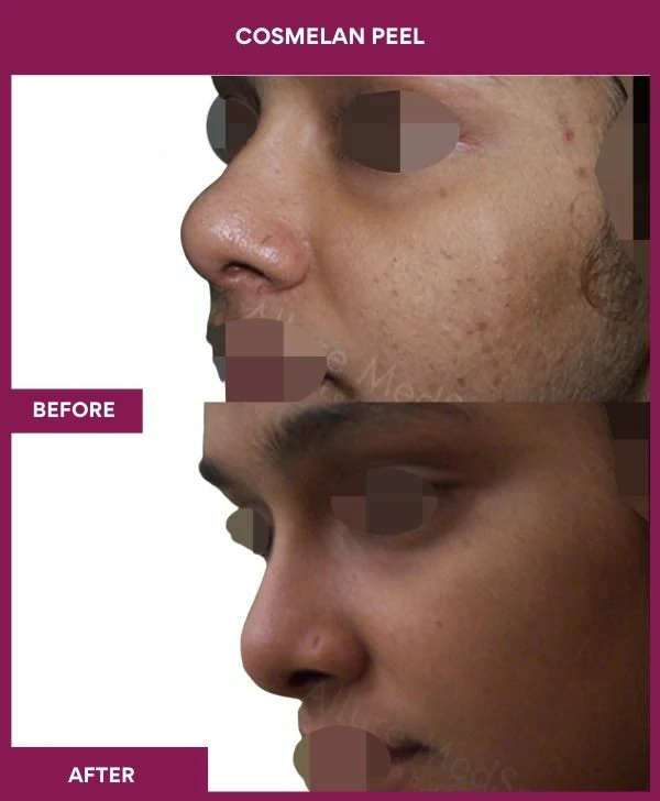 cosmelan-peel-treatment-before-after-results-mumbai-india-patient10-side-left