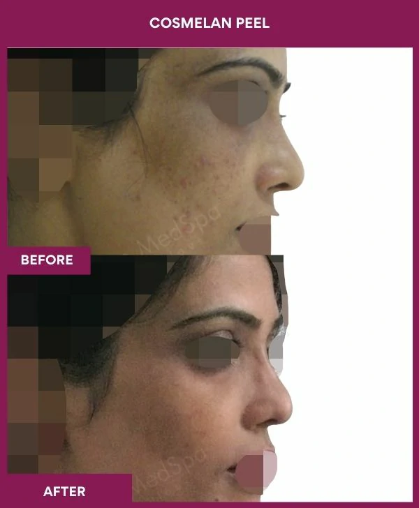 cosmelan-peel-treatment-before-after-results-mumbai-india-patient11-side-right