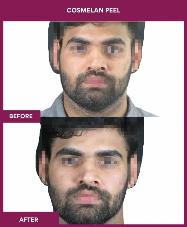 cosmelan-peel-treatment-before-after-results-mumbai-india-patient12-front