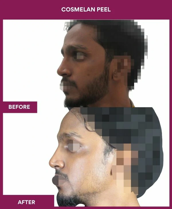 cosmelan-peel-treatment-before-after-results-mumbai-india-patient13-side-left