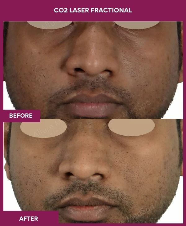 fractional-co2-laser-treatment-before-after-results-mumbai-india-patient01-front