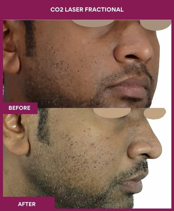 fractional-co2-laser-treatment-before-after-results-mumbai-india-patient01-side-right