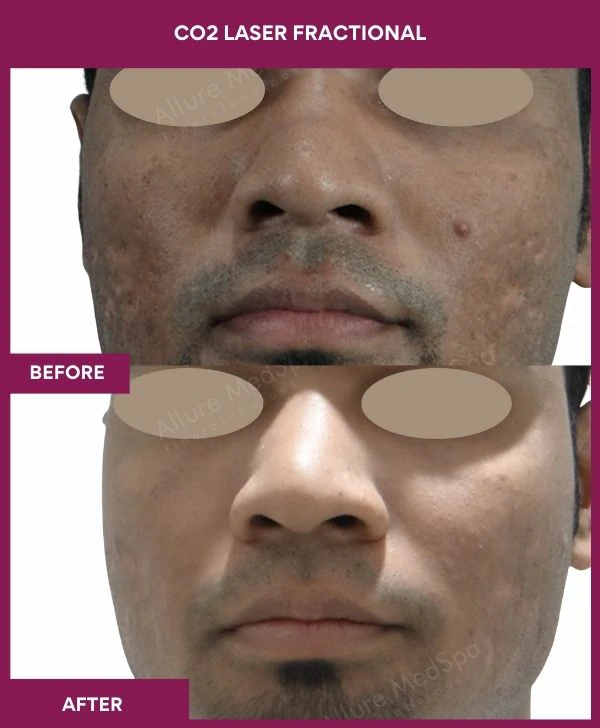 fractional-co2-laser-treatment-before-after-results-mumbai-india-patient02-front