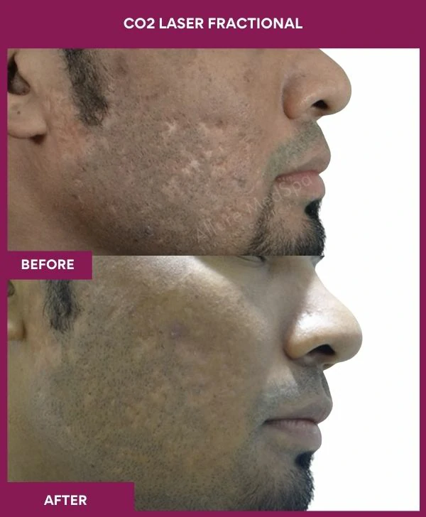 fractional-co2-laser-treatment-before-after-results-mumbai-india-patient02-side-right