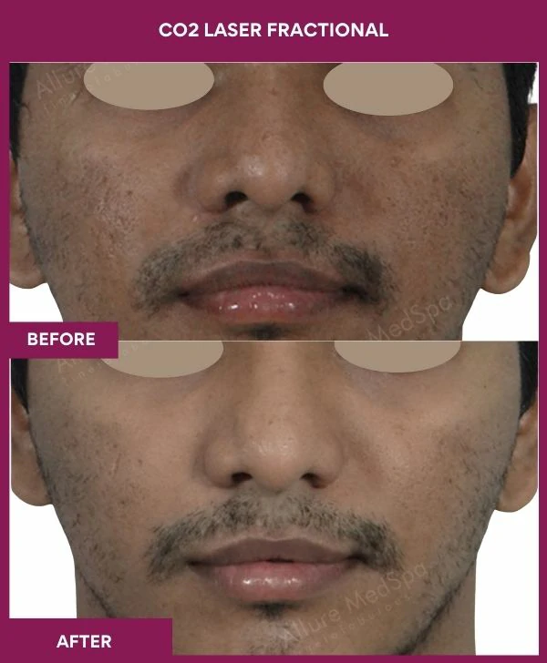 fractional-co2-laser-treatment-before-after-results-mumbai-india-patient03-front