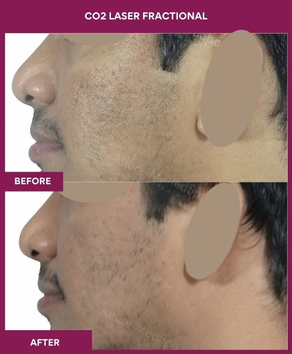 fractional-co2-laser-treatment-before-after-results-mumbai-india-patient03-side-left
