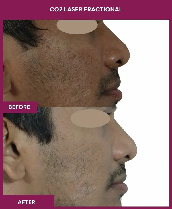 fractional-co2-laser-treatment-before-after-results-mumbai-india-patient03-side-right