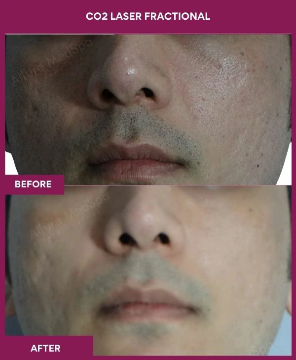 fractional-co2-laser-treatment-before-after-results-mumbai-india-patient04-front