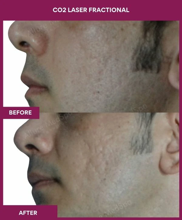 fractional-co2-laser-treatment-before-after-results-mumbai-india-patient04-side-left