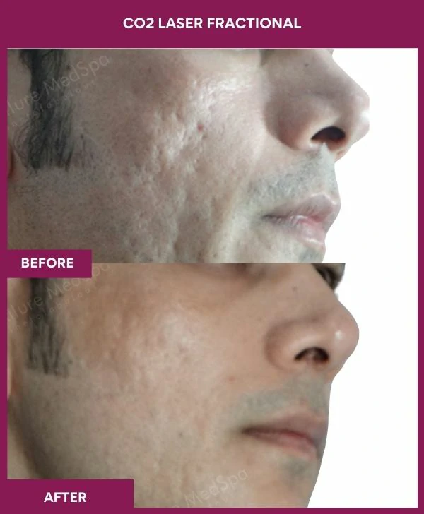 fractional-co2-laser-treatment-before-after-results-mumbai-india-patient04-side-right