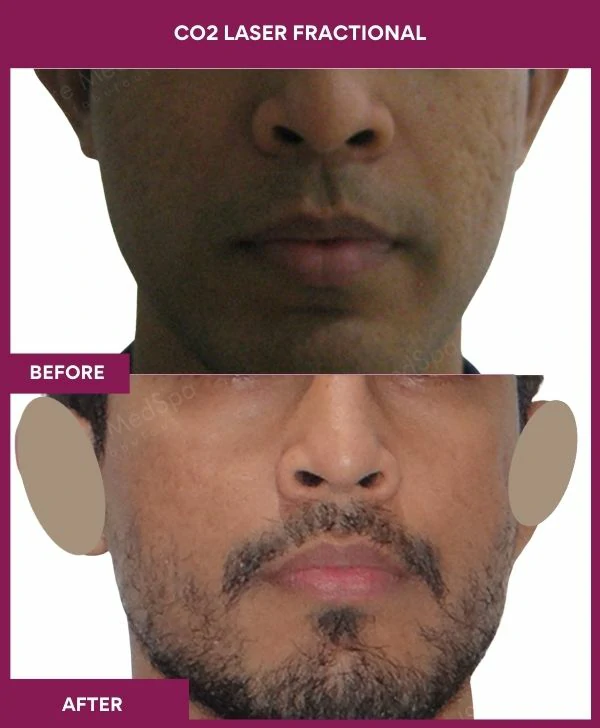 fractional-co2-laser-treatment-before-after-results-mumbai-india-patient05-front