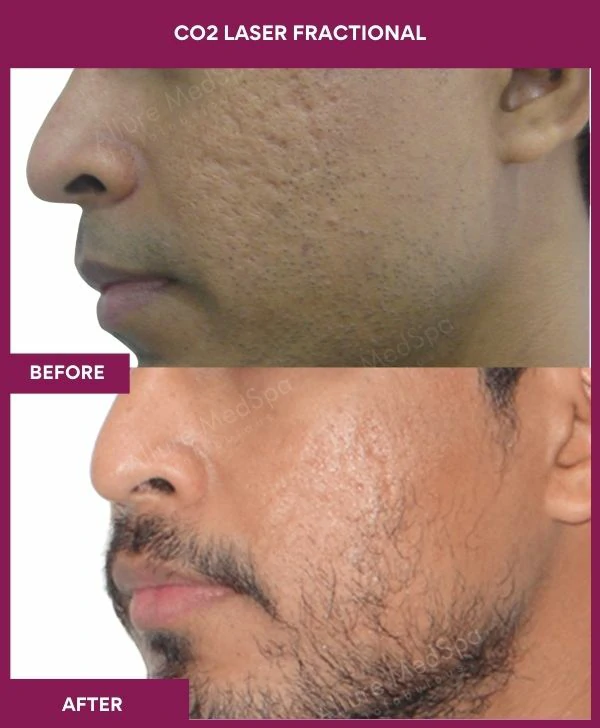 fractional-co2-laser-treatment-before-after-results-mumbai-india-patient05-side-left