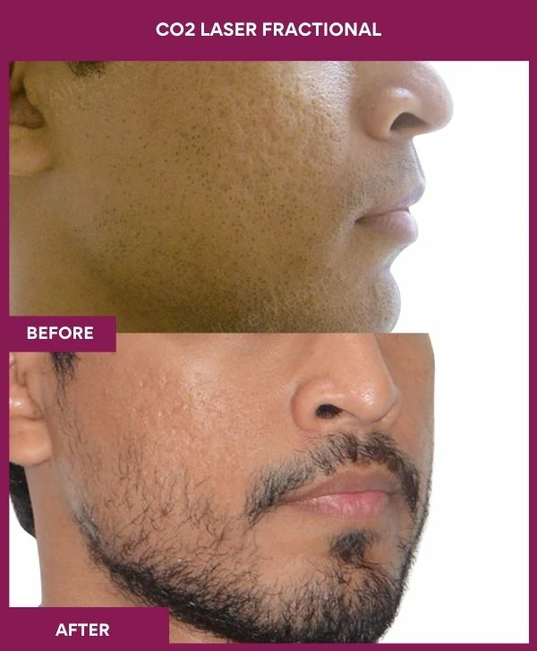fractional-co2-laser-treatment-before-after-results-mumbai-india-patient05-side-right