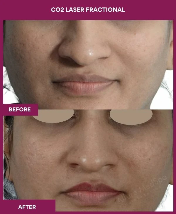 fractional-co2-laser-treatment-before-after-results-mumbai-india-patient06-front