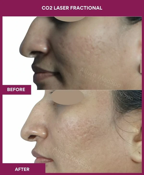 fractional-co2-laser-treatment-before-after-results-mumbai-india-patient06-side-left