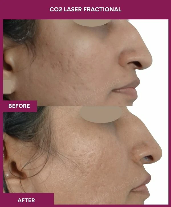 fractional-co2-laser-treatment-before-after-results-mumbai-india-patient06-side-right