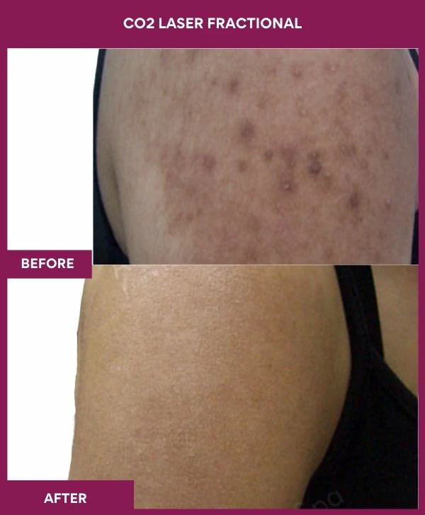 fractional-co2-laser-treatment-before-after-results-mumbai-india-patient07