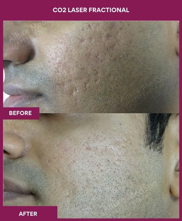 fractional-co2-laser-treatment-before-after-results-mumbai-india-patient08-side-left