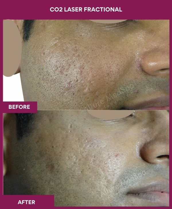 fractional-co2-laser-treatment-before-after-results-mumbai-india-patient08-side-right