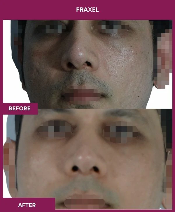 fraxel-laser-treatment-before-after-results-mumbai-india-patient01-front