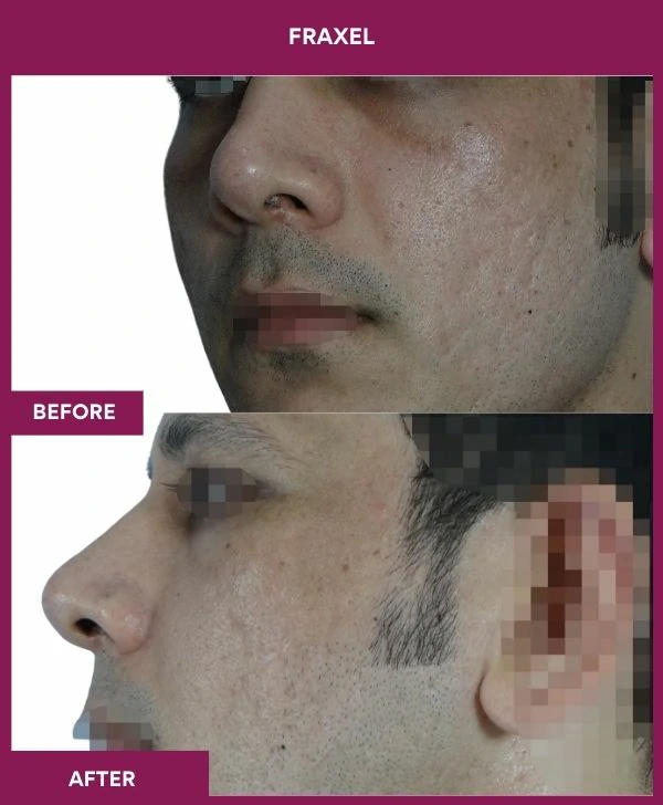 fraxel-laser-treatment-before-after-results-mumbai-india-patient01-side-left