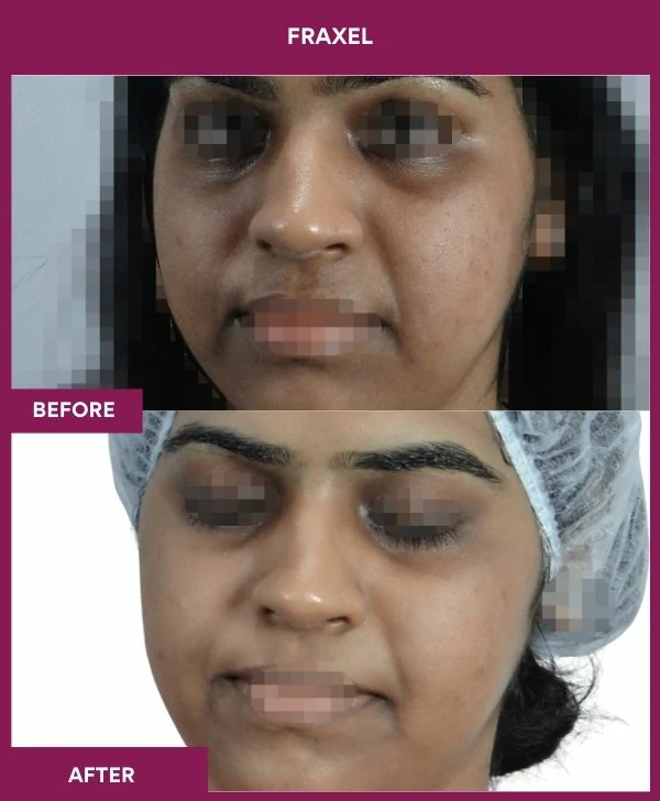 fraxel-laser-treatment-before-after-results-mumbai-india-patient02-front