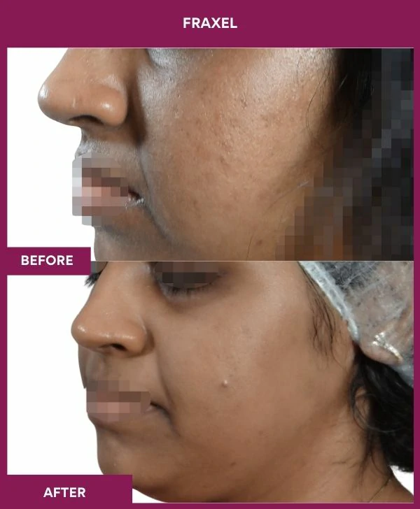 fraxel-laser-treatment-before-after-results-mumbai-india-patient02-side-left